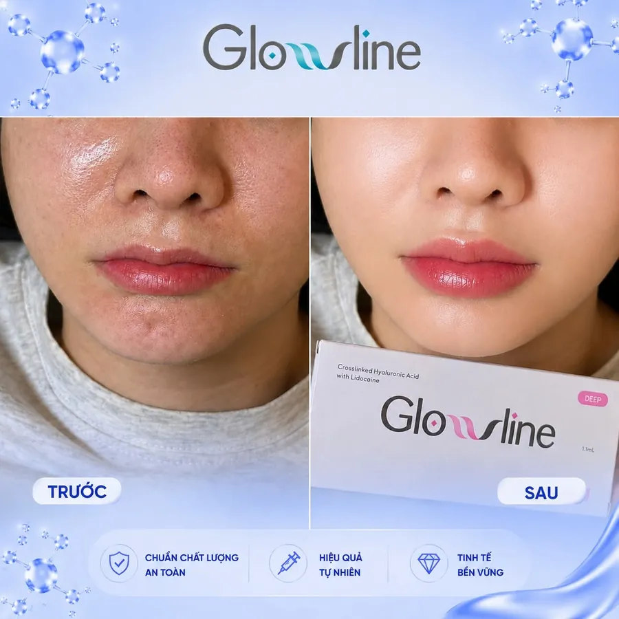 Trước và sau điều trị với Glowline, trường hợp 4